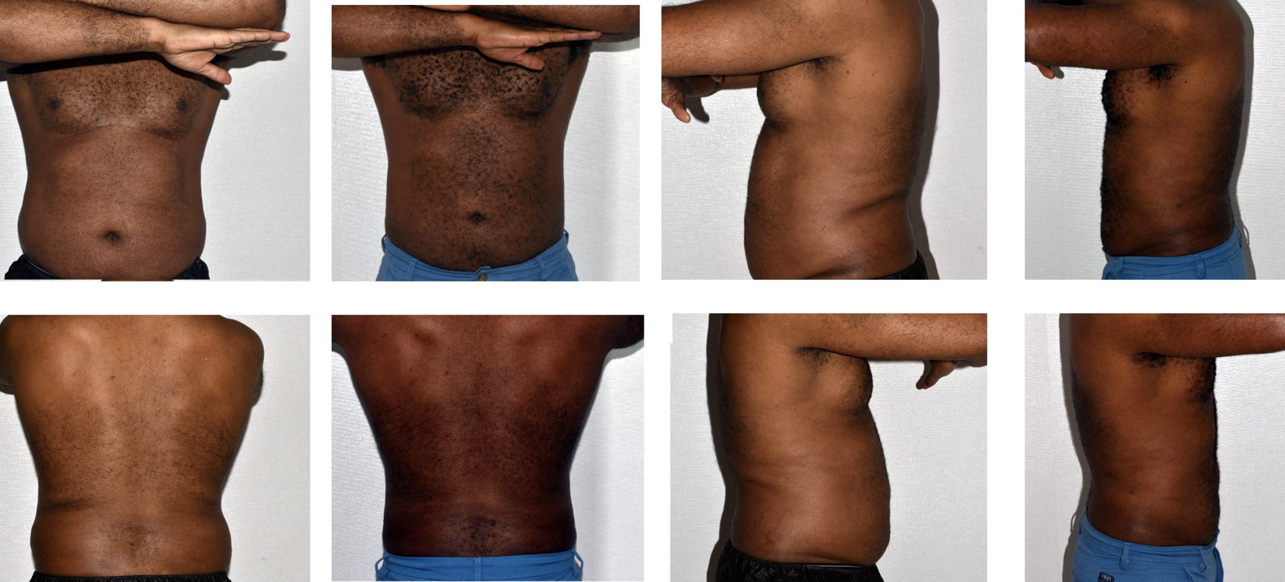 Eight side-by-side images show the before and after front, side, and back views of a shirtless person with medium brown skin, against a plain white wall background following Lipo 360.