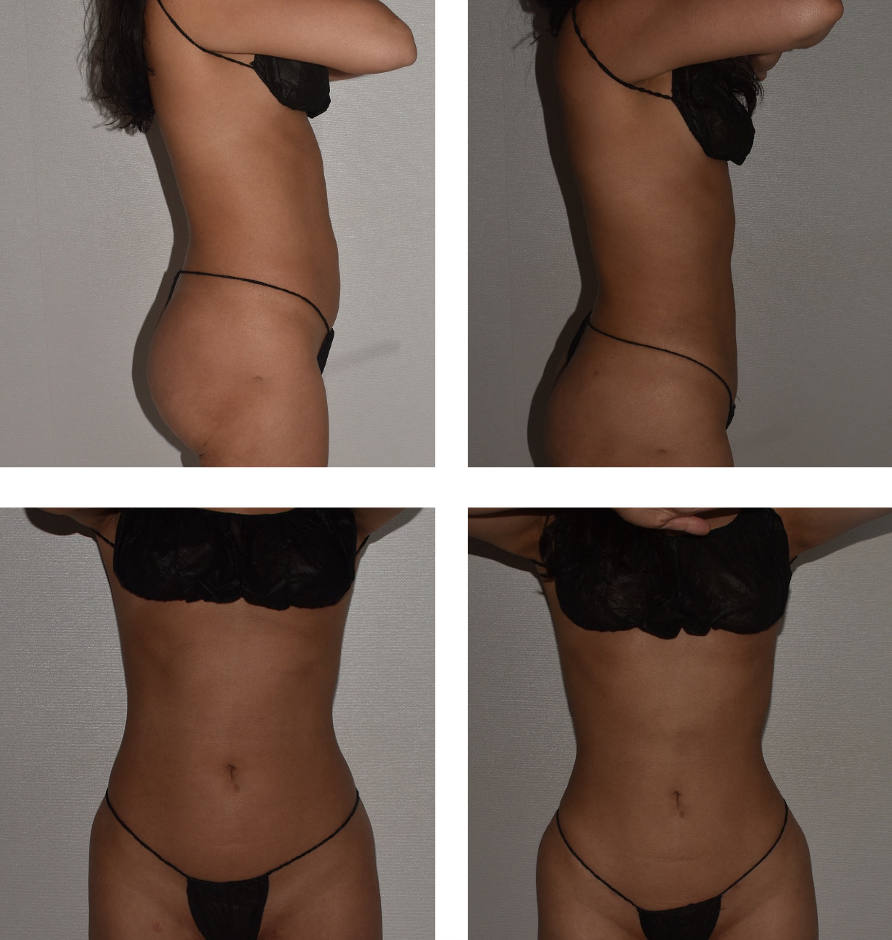 A woman wearing minimal black undergarments is shown in side and front views against a plain light-colored wall, providing clear before and after images for Lipo 360.