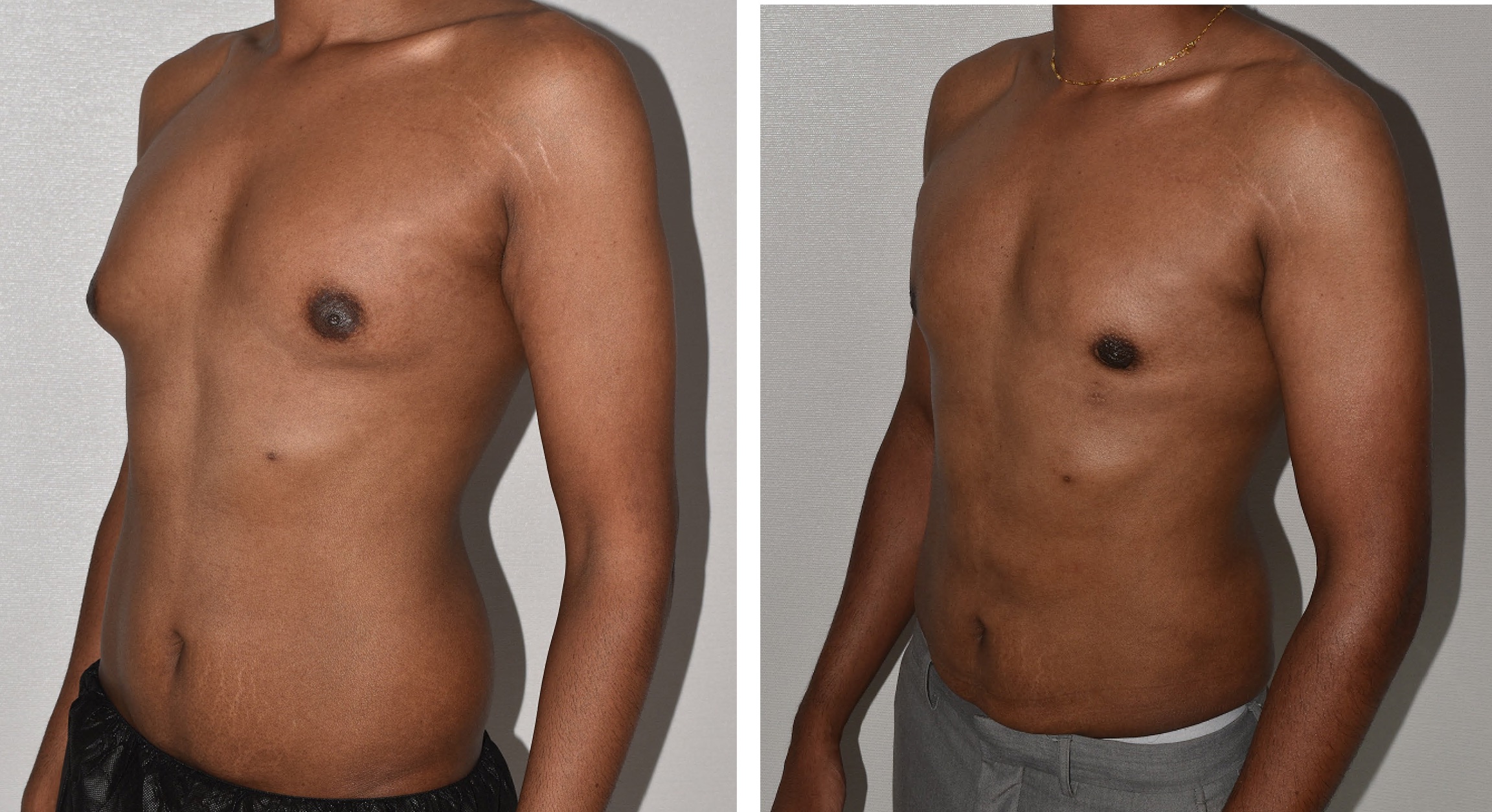 Side-by-side images showing a person’s chest before and after a Lipo 360 procedure, highlighting changes in chest contour and symmetry.