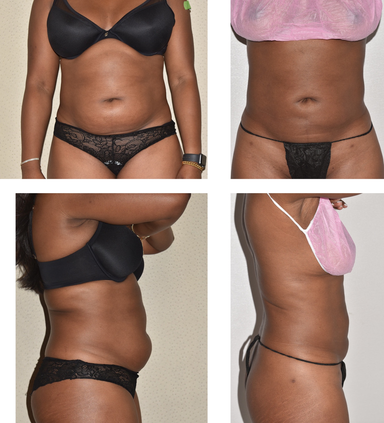 Before and after images show a woman in underwear from front and side angles, highlighting changes in the abdominal area following a cosmetic body procedure.