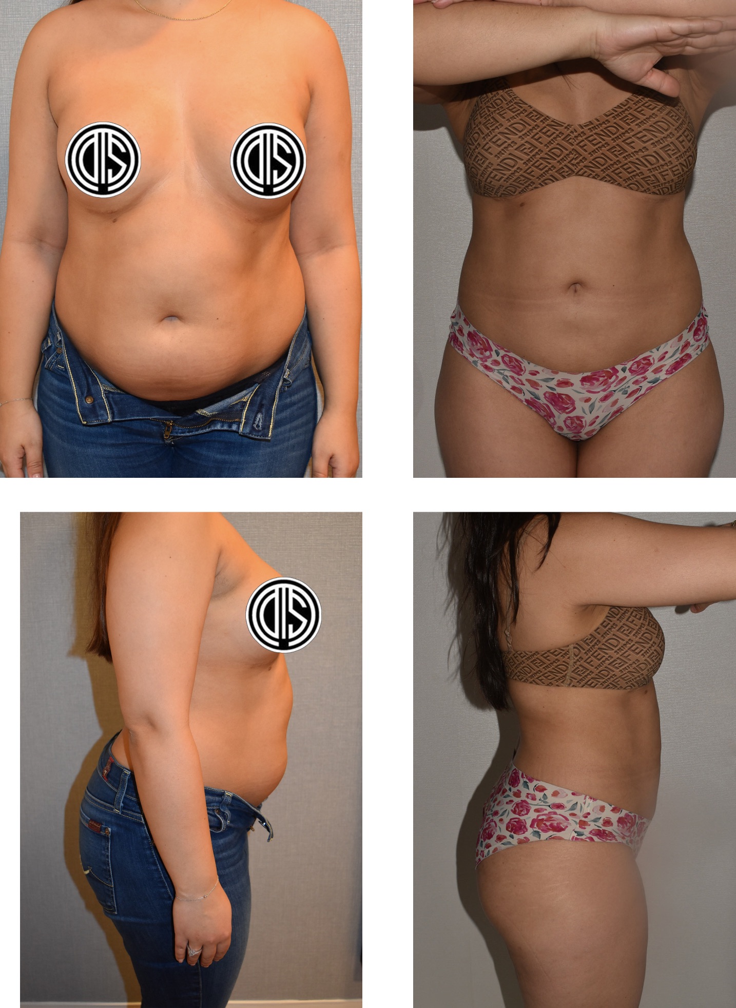 Before and after images of a woman displaying physical changes in her abdomen and torso from the front and side views, wearing underwear and a bra; potential signs of Paradoxical Adipose Hyperplasia are also shown.