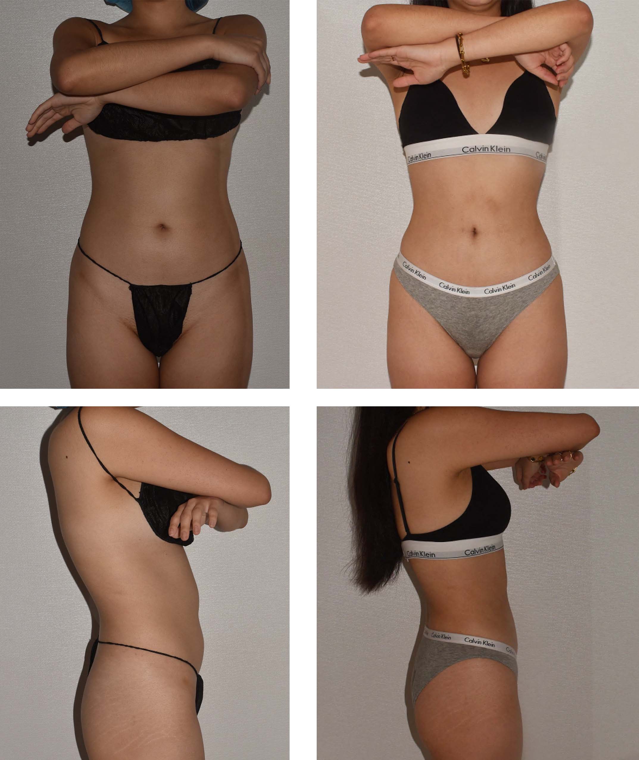 Four-panel image showing before and after images of a woman in underwear; two front and two side views with crossed arms, highlighting her body from shoulders to thighs against a plain background—ideal for showcasing Lipo 360 results.