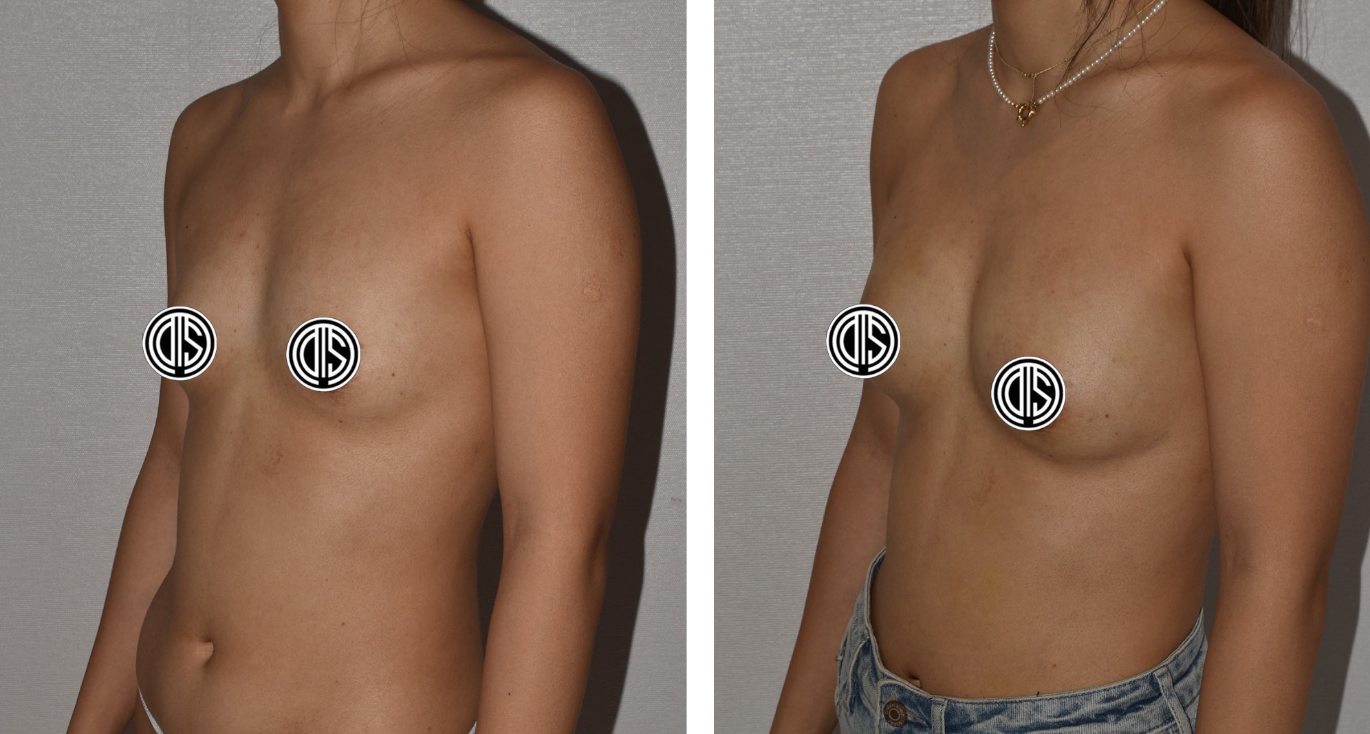 Two side-by-side photos of a topless woman from the waist up in jeans and necklaces, with circles covering her nipples, serve as Breast Fat Transfer before and after images.