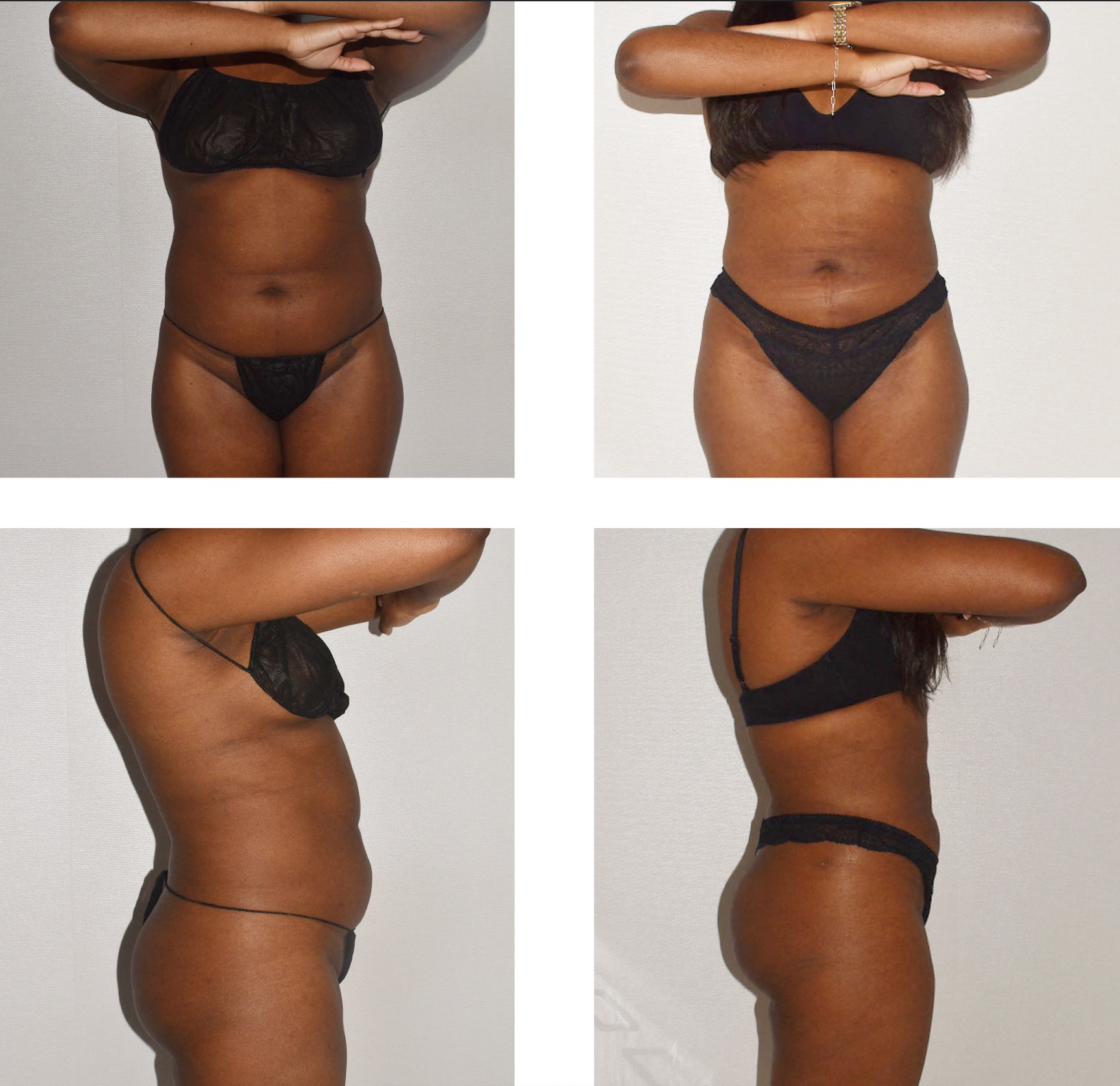 Four images show a woman in black underwear standing against a white background, arms raised to cover her face; the front, back, and both sides are displayed—ideal for before and after Lipo 360 comparisons.