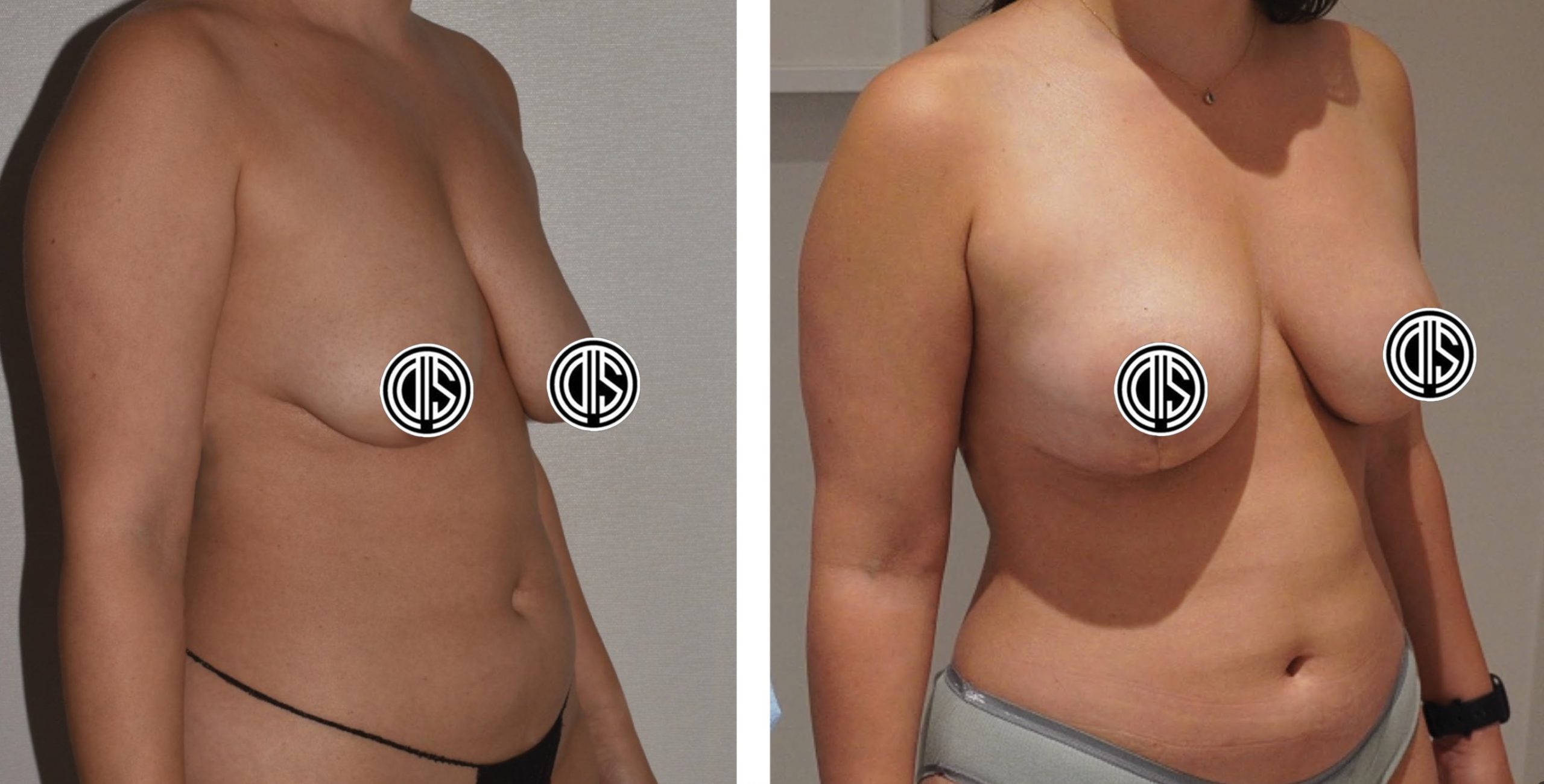 Two women shown from the side, topless with graphics covering their nipples, revealing their torsos and natural breast shape as part of before and after images for breast fat transfer.