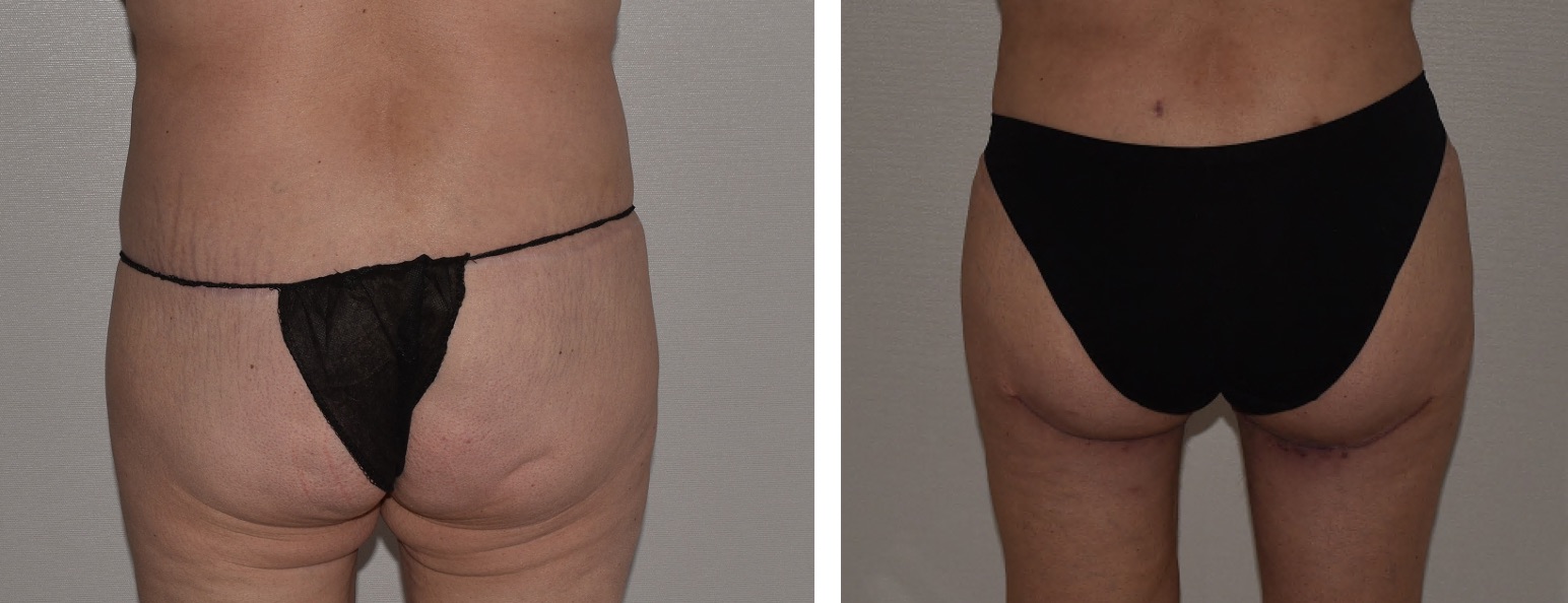 Side-by-side photos showing a person's lower back and buttocks before (left) and after (right) a cosmetic procedure, with different black undergarments worn in each image.