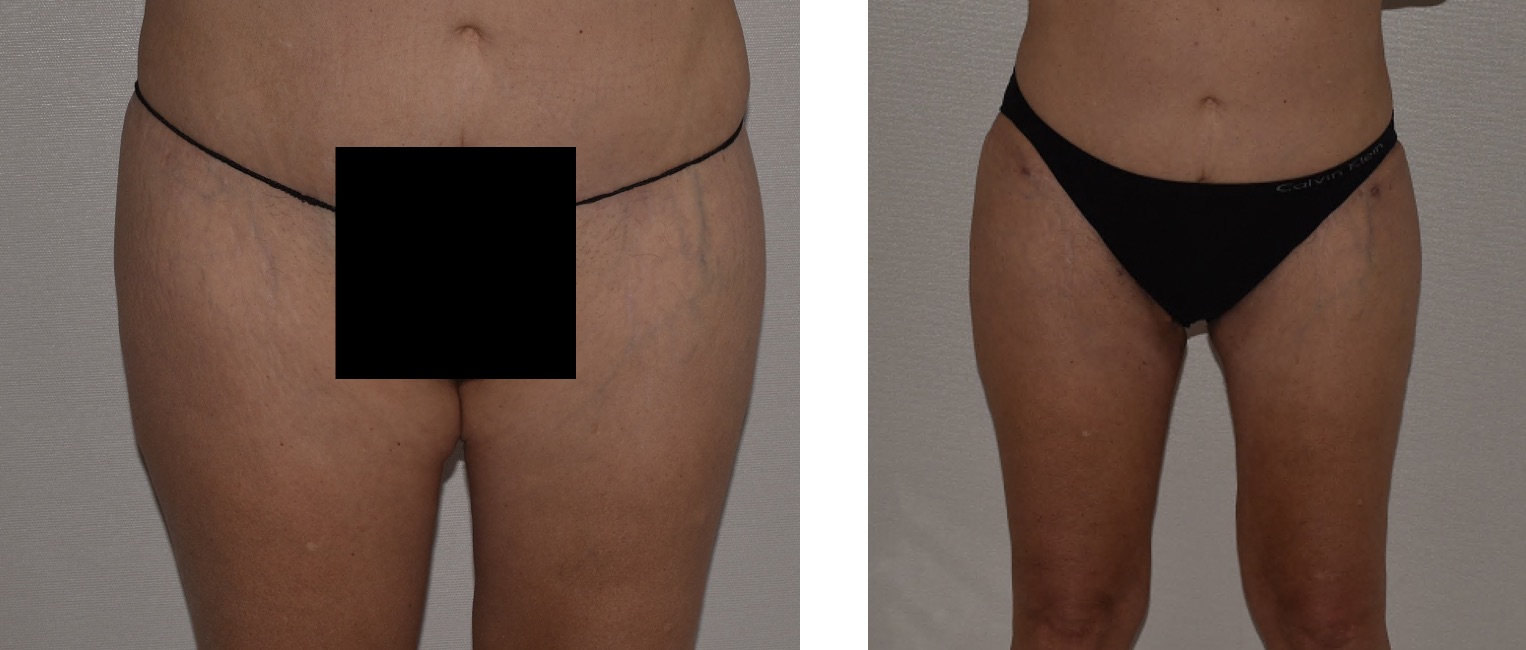 Two side-by-side photos show a woman's upper legs before and after a cosmetic procedure; the left image is partially censored, while the right shows more defined contours.