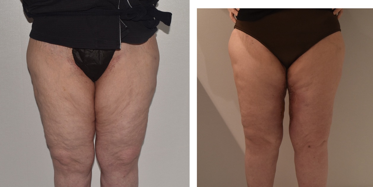 Two side-by-side photos showing the front view of a woman's upper legs before and after a cosmetic procedure; the right image shows smoother skin and a slimmer appearance.