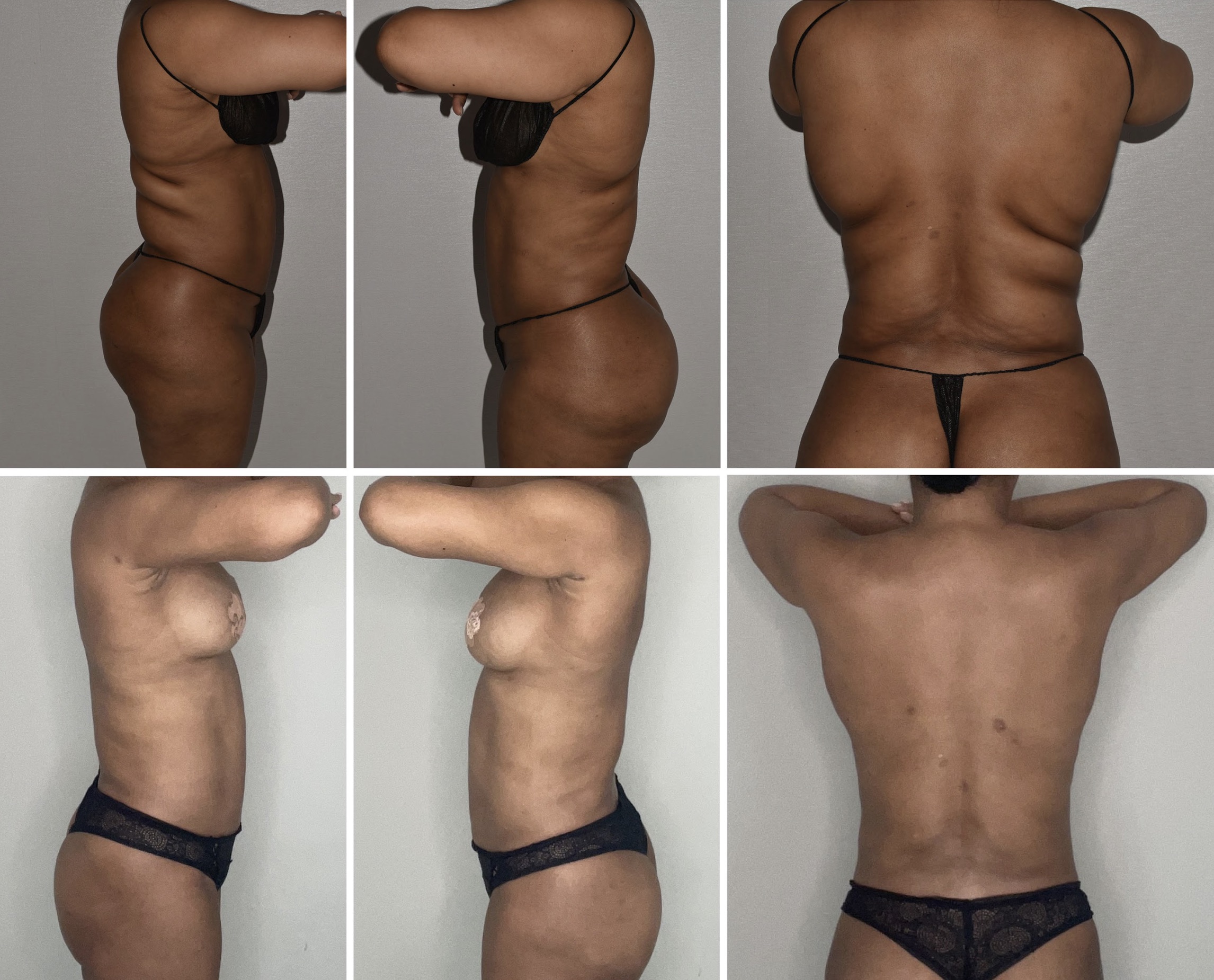 Six side and back view images show a woman in underwear before and after a Lipo 360 procedure, highlighting changes in body shape and skin appearance.
