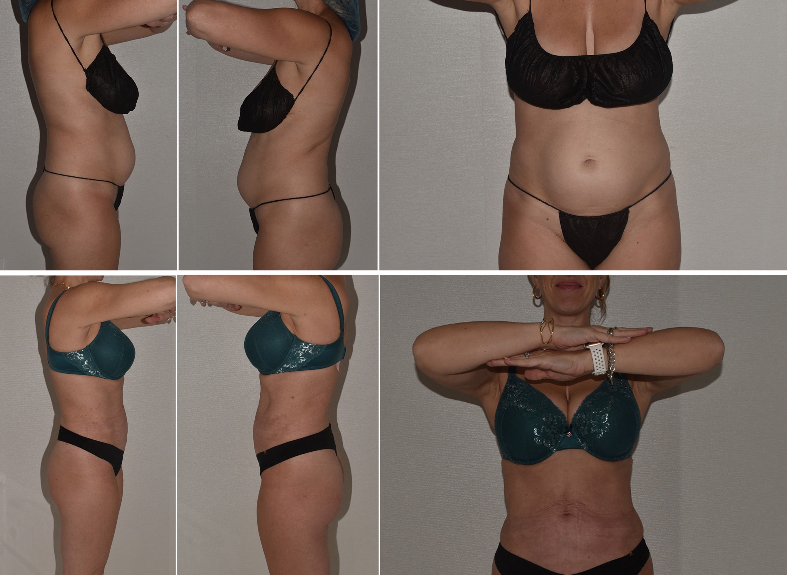 Before and After Images of a woman’s torso and abdomen, highlighting changes in body contour and skin appearance from various angles; useful for evaluating results and monitoring concerns like Paradoxical Adipose Hyperplasia (PAH).