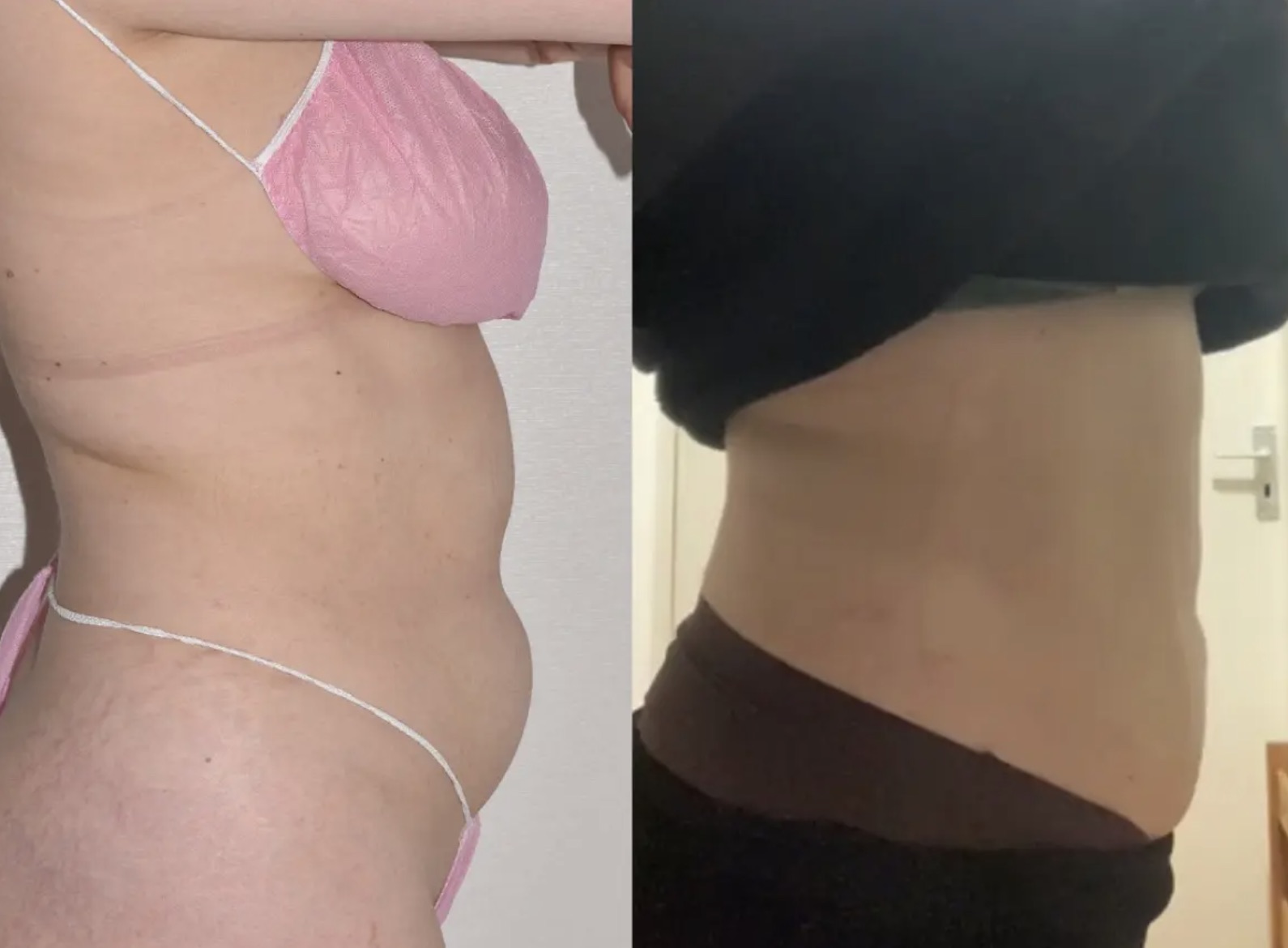 Side-by-side images of a person's midsection before and after show a noticeable reduction in abdominal size.