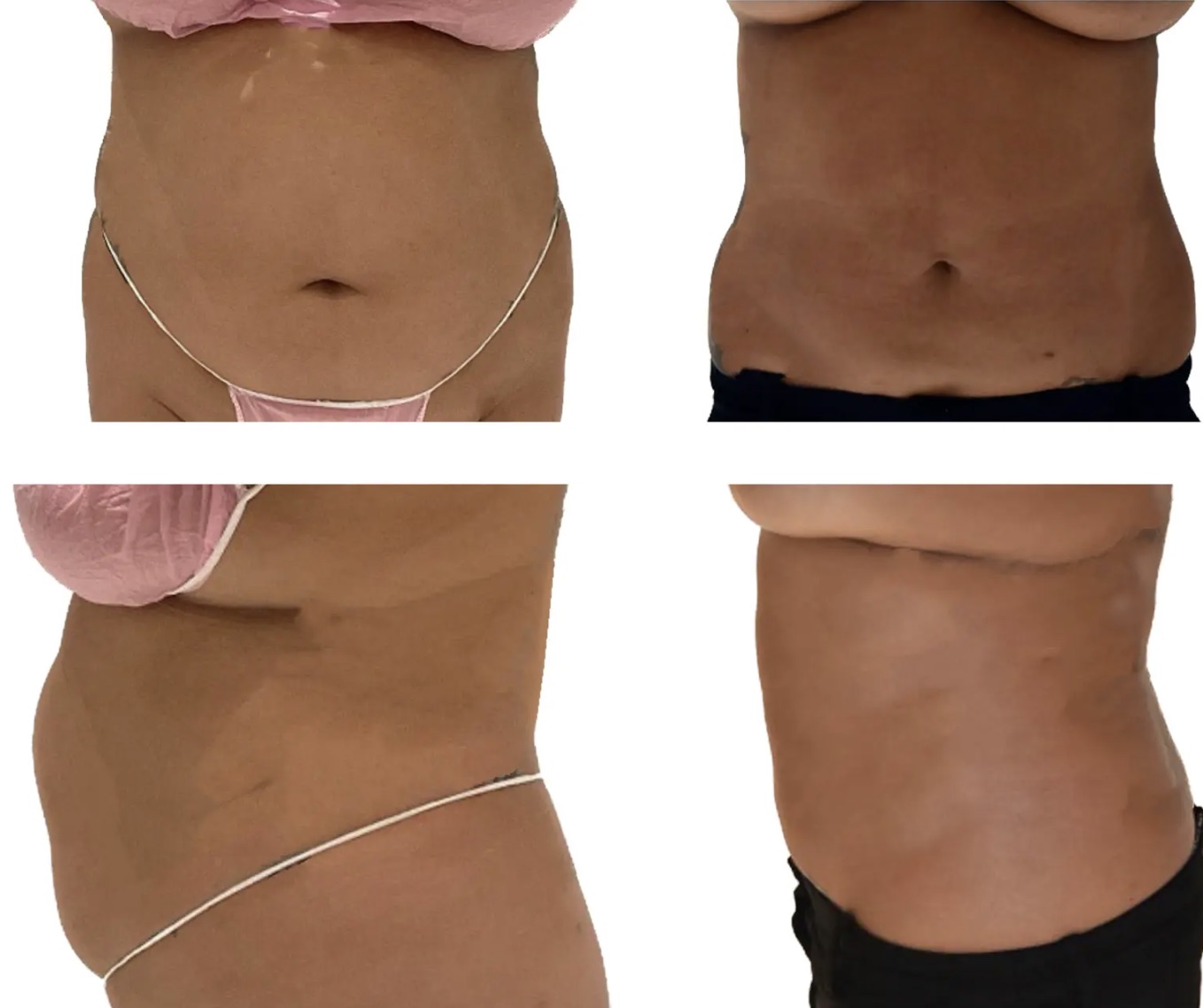 Side-by-side before and after images show a woman's abdomen from the front and side, highlighting a visible reduction in abdominal size without signs of PAH (Paradoxical Adipose Hyperplasia).