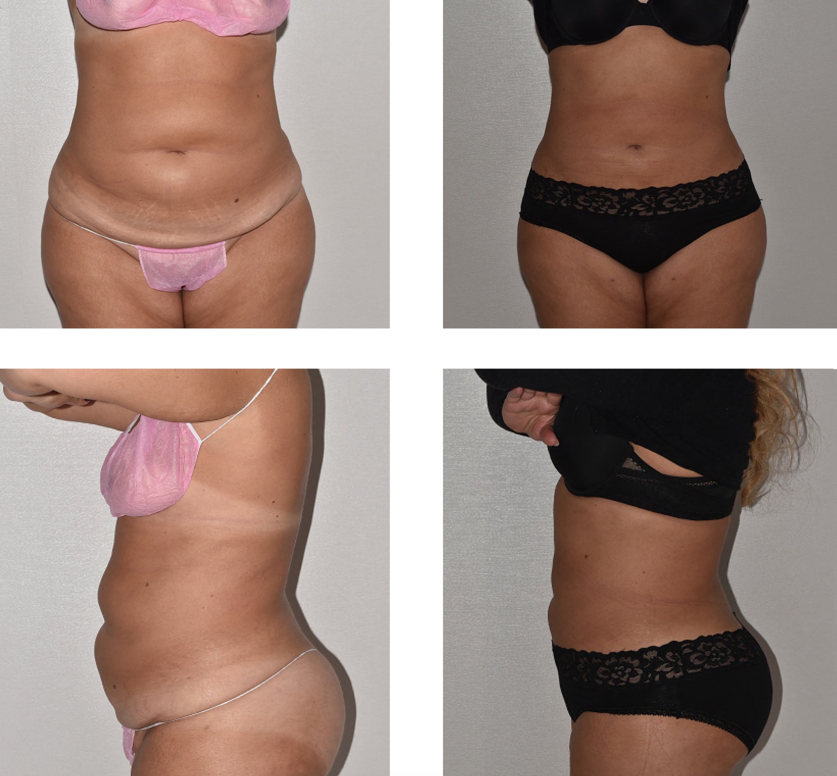 Four photos showing a woman’s torso before and after body contouring, from front and side views. These Before and After Images highlight reduced abdomen size without signs of Paradoxical Adipose Hyperplasia.