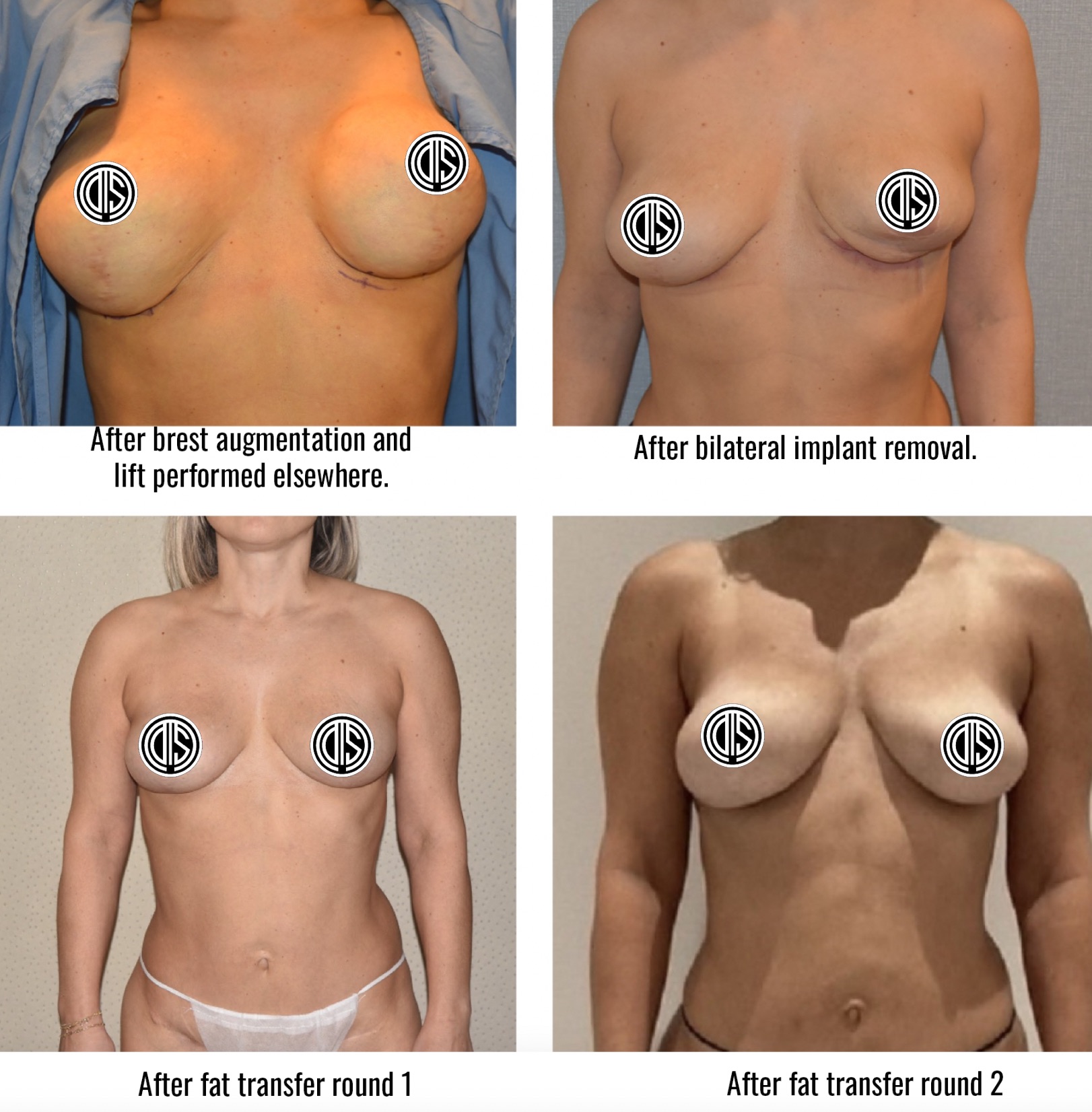 A collage of before and after images showcasing different breast implants.