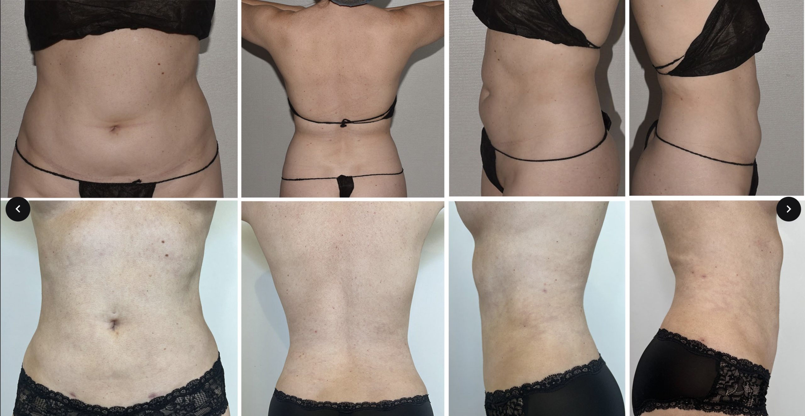 Two rows of comparison photos show a woman’s torso from front, back, and side angles. The Before and After Images highlight the impressive changes following her body transformation or Lipo 360 procedure.