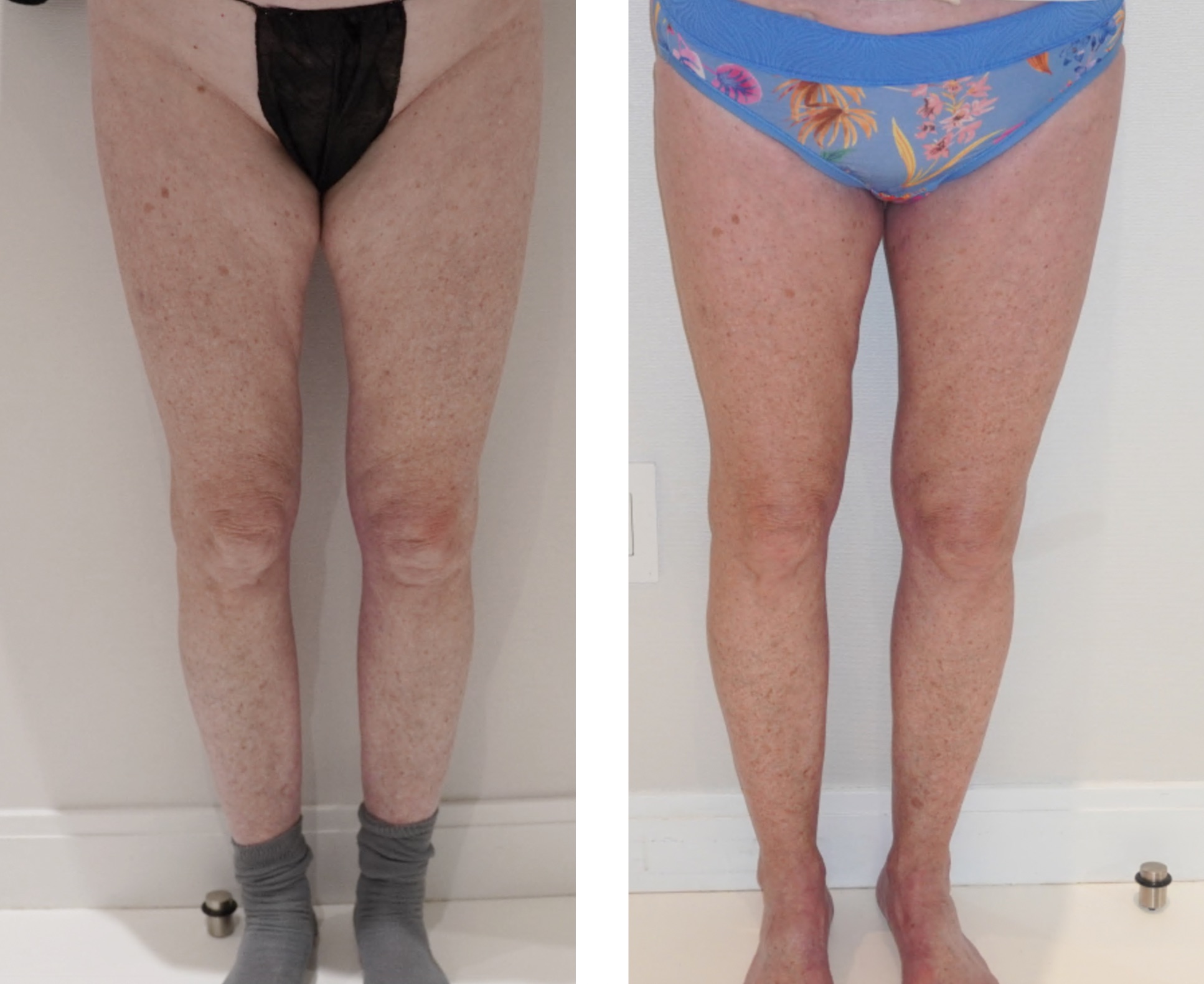 Two side-by-side photos show a person standing, legs visible from mid-thigh to feet, wearing different underwear; left shows black with socks, right shows blue patterned with bare feet.