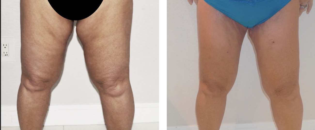 Before and after photos showing the front view of a person’s legs, with visible reduction in skin irregularities and smoother appearance in the after image.