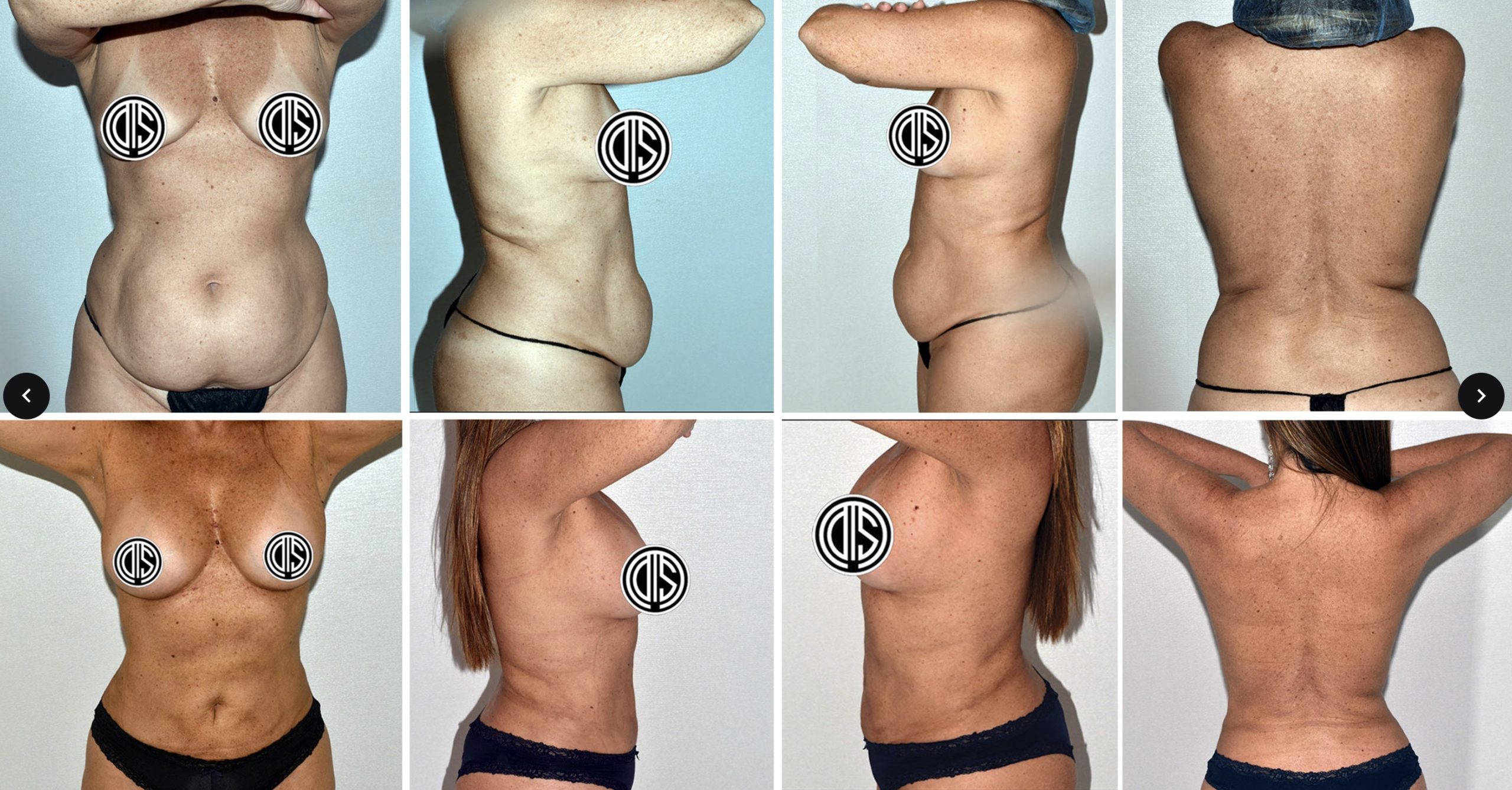 A series of before and after images featuring a woman from various angles, highlighting changes in her abdomen, waist, chest, and back after Lipo 360 cosmetic surgery.