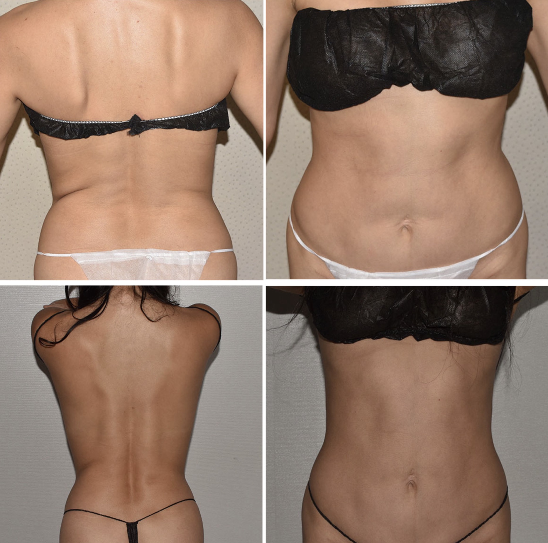 Before and After images showing a woman's back and torso, highlighting changes in body shape and contour, possibly from a Lipo 360 cosmetic procedure.