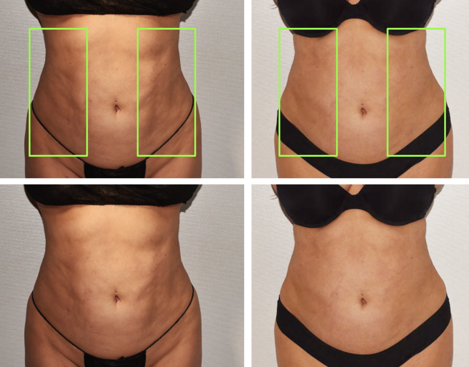 Side-by-side before and after images of a woman’s midsection, shown from the front and back, highlight liposuction results and changes in body contour within green boxes.