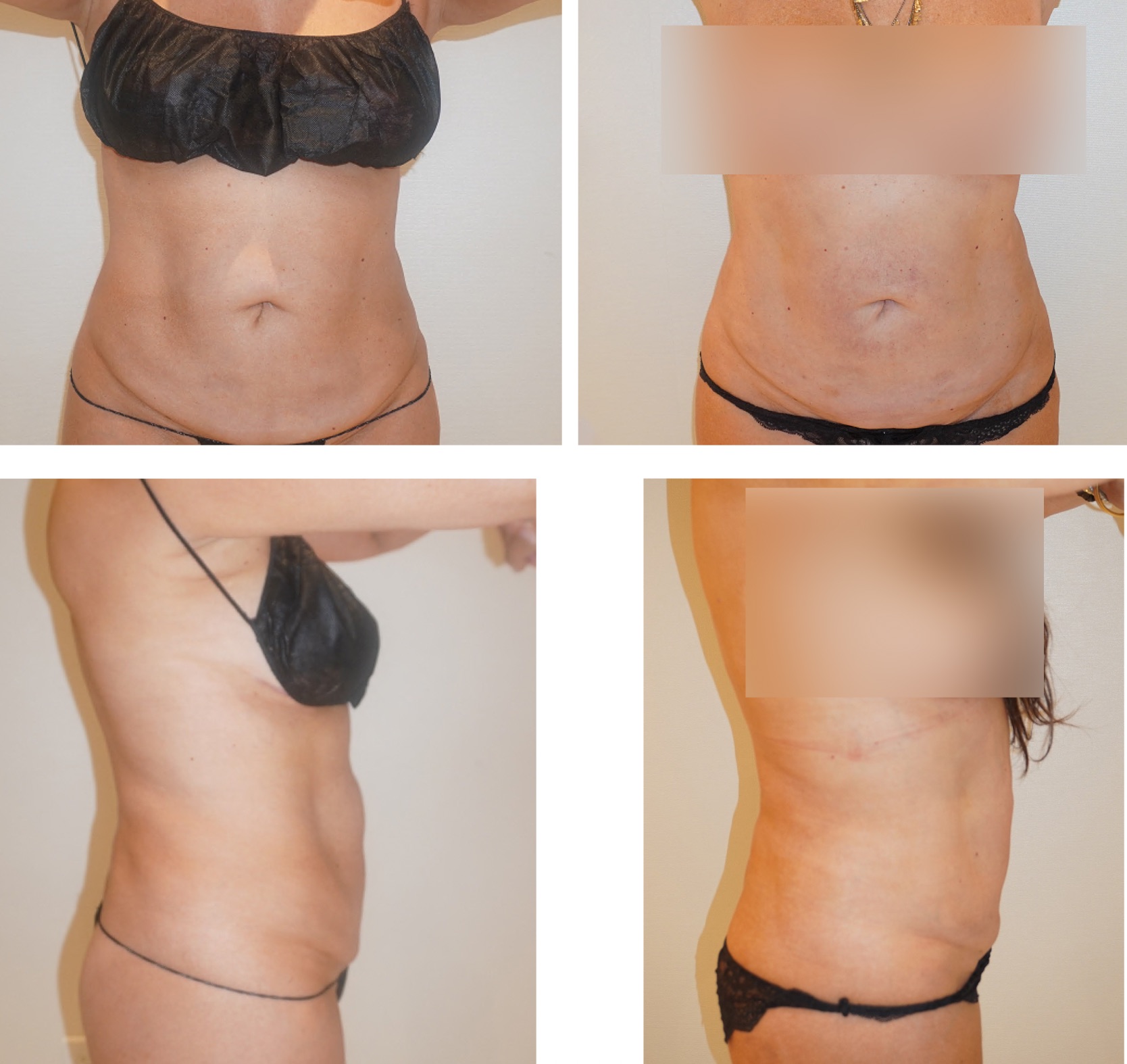 Before and after images display a woman’s torso from the front and side, highlighting changes in abdominal contour after liposuction revision. Parts of the chest are blurred for privacy.
